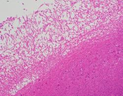 Figure 2. Mat of fungi over air sac nodule.  H&E.