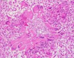 Figure 3.  Pulmonary fungal granuloma. H&E.