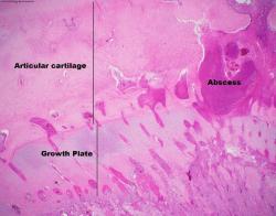Figure 4.  Abscess spanning growth plate and  articular cartilage. H&E.