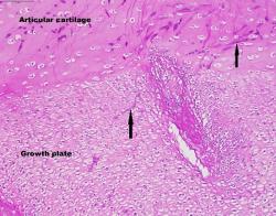 Figure 6. Fungal hyphae (arrows). PAS.