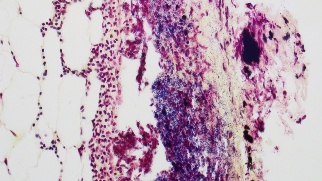 Figure 1. Periocular adipose tissue with lymphohistiocytic inflammation and abundant gram-positive cocci. (Gram stain) 