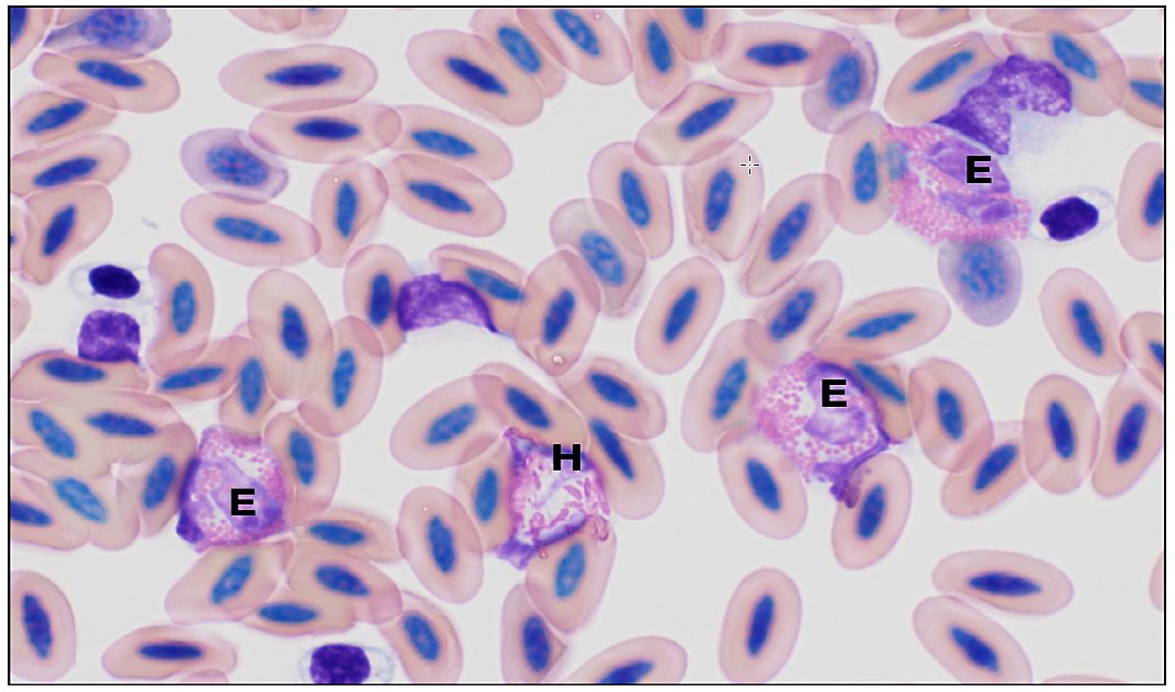 Figure 1. Blood smear examination showing eosinophilia. Eosinophils (E) can be distinguished from heterophils (H) by their smaller round eosinophilic-staining granules. Wright’s stain, 100x