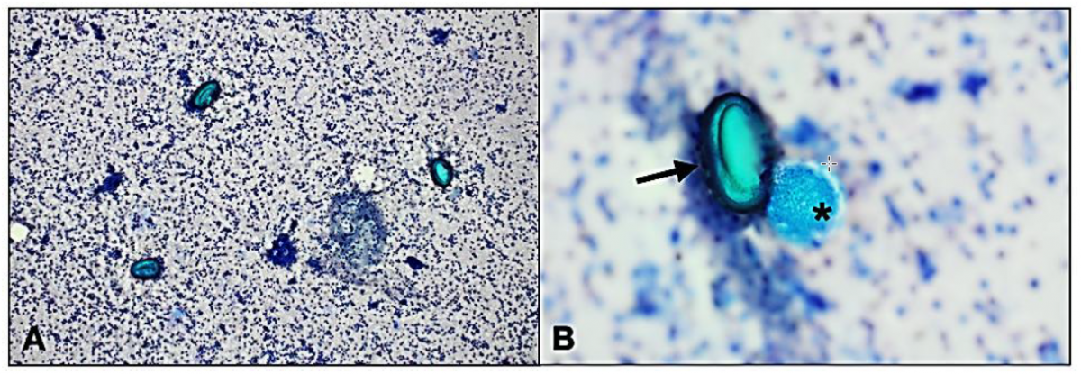 Figure 2. Cytology smears of endotracheal tube fluid. 2A. Several oval structures are observed within a proteinaceous background with mixed inflammatory cells. Wright’s stain, 10x. 2B. Oval structures compatible with parasite ova (arrow) and vesicular structure of unknown significance with granular content (asterisk). Wright’s stain, 40x.