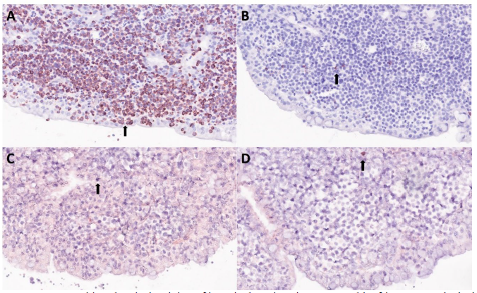 Figure 2. Immunohistochemical staining of intestinal sections in a 2-year-old African pygmy hedgehog with intestinal T-cell lymphoma. A. Neoplastic lymphocytes within the lamina propria as well as intra-epithelial lymphocyte clusters (arrow) show strong positive membranous immunoreactivity, consistent with T-cell lineage. CD3 stain. B. CD20, C. CD79a, and D. PAX5 stains. Neoplastic lymphocytes fail to show immunoreactivity with few to rare individual immunoreactive B-lymphocytes (arrows) being scattered in the background. 