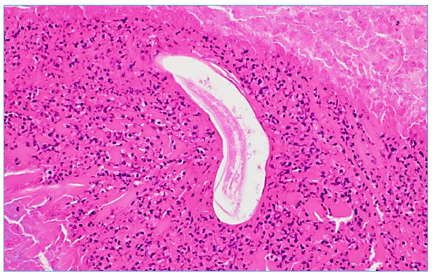 Figure 1. Equine, conjunctiva. The necrotic remnants of an elongate spirurid nematode. H&E stain