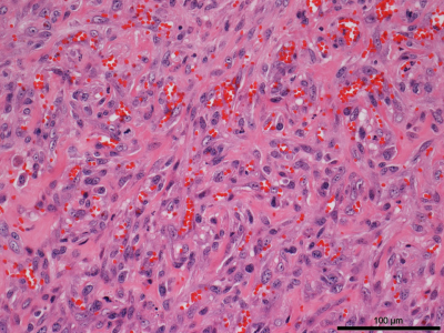 Figure 1. Cutaneous hemangiosarcoma in a 2-year-old horse.  Plump neoplastic spindle (endothelial) cells forming multiple small, haphazardly arranged blood-filled spaces. H&E stain.