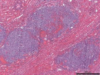 Figure 2. Kidney, histologic section. Nodules identified on gross exam correspond to multiple aggregates of neutrophils mixed with hemorrhage, fibrin, and bacteria. Hematoxylin and eosin stain 