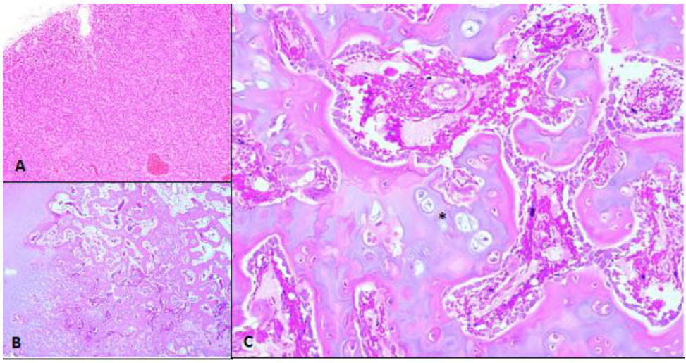 Figure 1. Bone and thyroid gland in a Dutch warmblood foal. A. Hyperplastic follicular epithelium in the thyroid gland.  B, C. Cuboidal bone histology (B - 4x, C - 20x) with incompletely ossified endochondral bone composed of a high proportion of hyaline cartilage (*). H&E stain.
