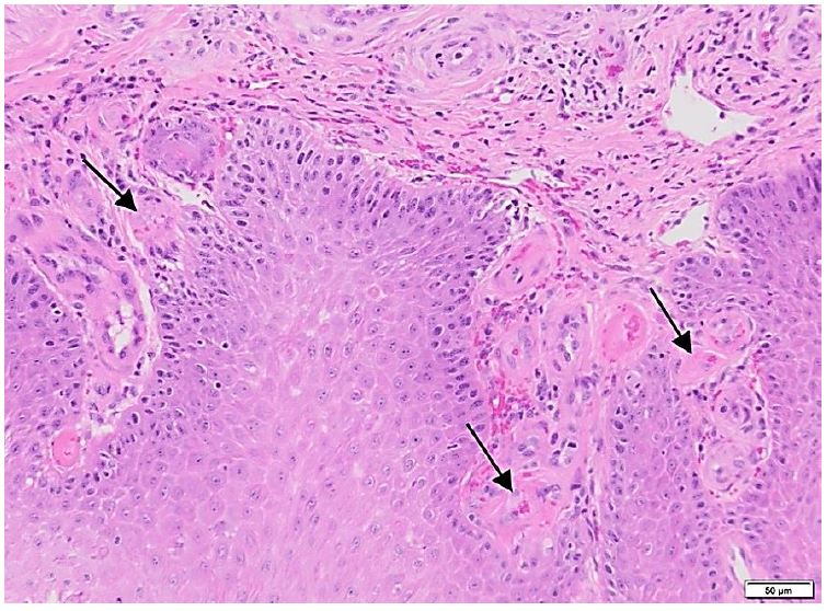 Figure 2. Superficial dermal blood vessels with mural thickening, perivascular fibrin and fragmented erythrocytes (black arrows).  H&E.