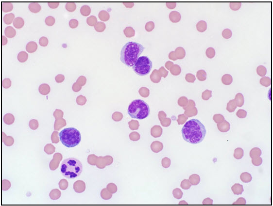  Blood smear examination. There is a population of atypical lymphocytes with frequent nuclear indentation. Wright’s stain (400X). 