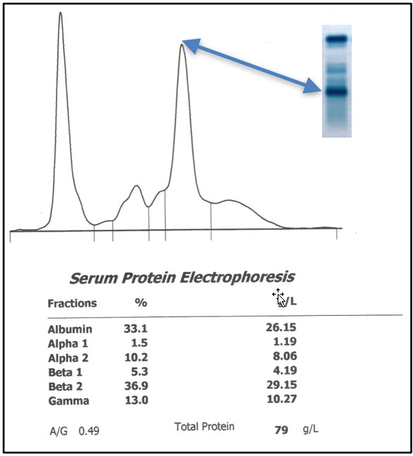  Serum protein electrophoresis. The discrete band noted on the cellulose acetate strip (insert) is represented by a narrow-based peak in the beta-2 globulin region of the densitogram, consistent with a monoclonal gammopathy. 