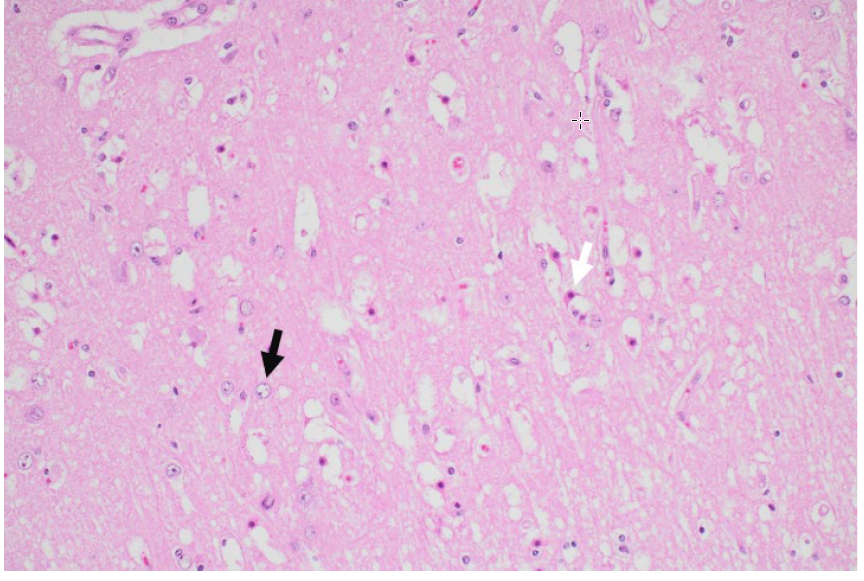   Higher magnificent view of an area of vacuolation showing swollen astrocytes (black arrow) and shrunken, dead neurons (white arrow). 
