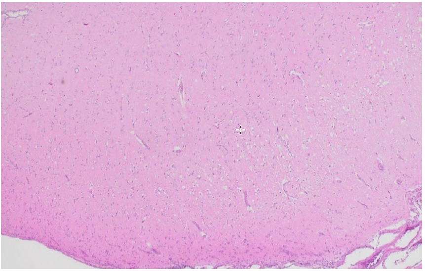Figure 1.  Vacuolation of the grey matter of the middle cortical lamina is evident on the right-hand side of the image.  This is characterized by clear (white) spaces within the background of the neuropil (pink). The tissue on the left-hand side of the image is unaffected. 