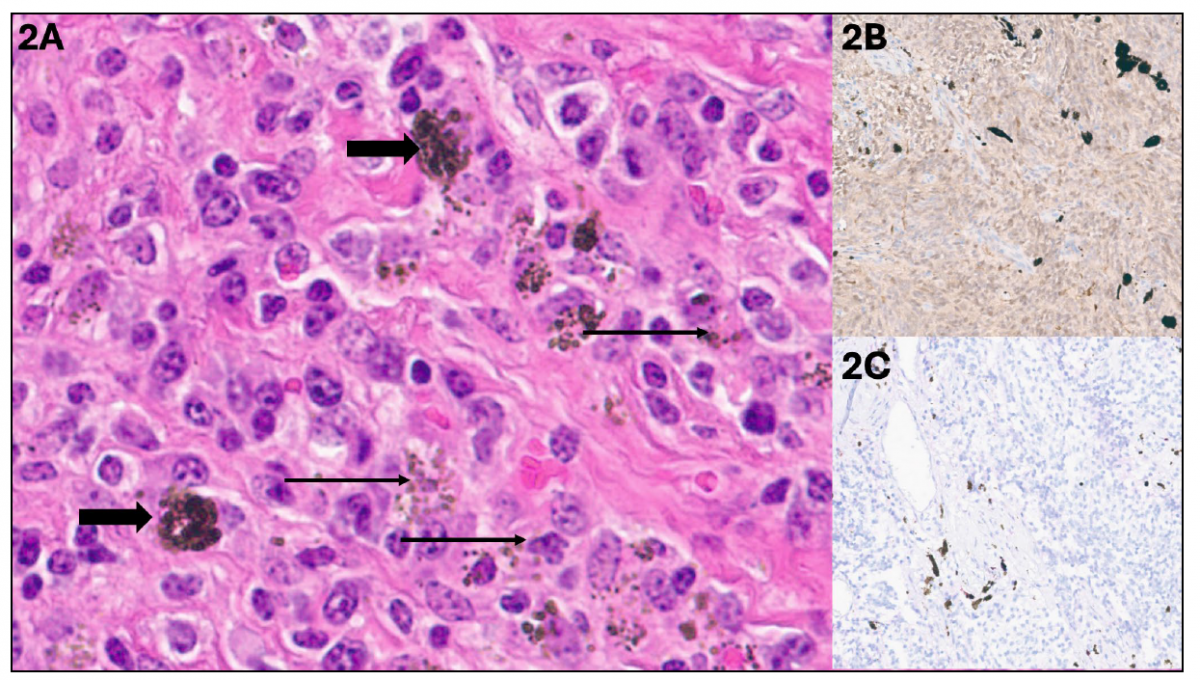 Figure 2. Ocular mass. 2A. 40X. The cells in this field are mostly round to polygonal in shape. There are scattered deeply pigmented cells, interpreted as melanomacrophages (thick arrow). There is scattered melanin pigment which could be within the interstitium, or possibly within the cytoplasm of the neoplastic cells (thin arrow). 2B. 10X. IHC S110; brown chromogen. There is strong cytoplasmic labelling of the neoplastic cells with S100. 2C. 10X. IHC MelanA/PNL2; purple chromogen. No labelling of cells with MelanA/PNL2 was detected.