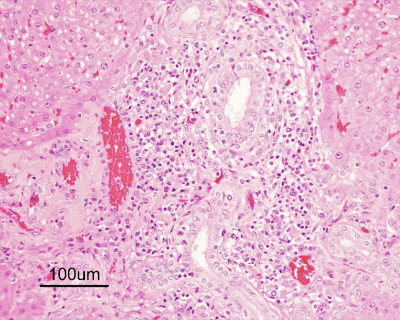Figure 1. Lymphoplasmacytic portal hepatitis.  H&E stain.