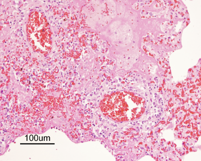 Figure 2. Mild pulmonary perivascular lymphoplasmacytic cuffing with localized acute alveolitis. H&E stain.