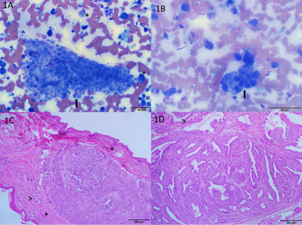 Figure 1. Mammary tumor in the teat of a male neutered dog. A,B - Direct smears from a fine needle aspirate (Wright’s).  Clusters of epithelial cells (arrows) and macrophages (*) within a background of hemorrhage. C,D - Excisional biopsy (H&E). An epithelial mammary tumor within the mammary duct of a teat. 1C. There is smooth muscle surrounding the expanded mammary duct (*). 1D. Secretion is evident within tubules (>). 