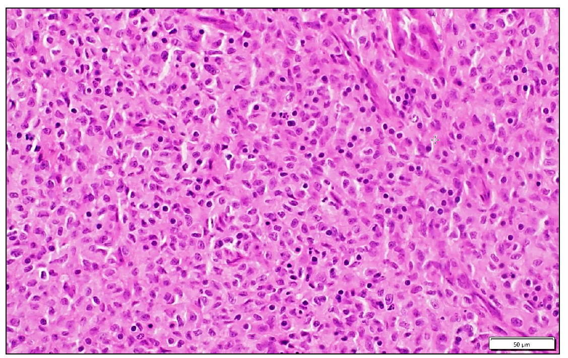 Figure 1. This cutaneous neoplasm is composed of sheets of round to spindle-shaped cells. Cytoplasmic granules are not visible in the neoplastic cells with hematoxylin and eosin staining. H&E stain.
