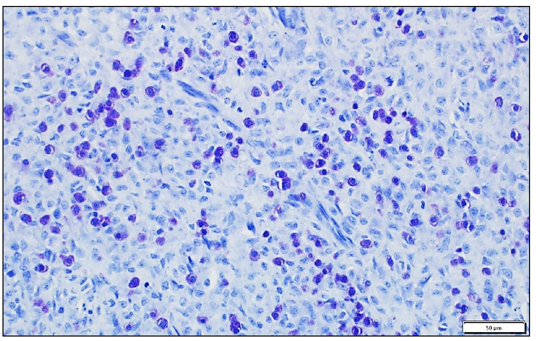 Figure 2. Few to many red-purple cytoplasmic granules are appreciated in most neoplastic cells with toluidine blue staining. TB stain.
