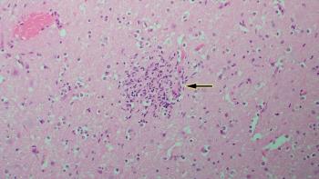 Figure 2. Focus of malacia and gliosis in the brain (arrow)