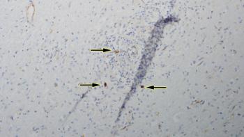 Figure 3. Positive IHC staining for Toxoplasma gondii antigen in a malacic and gliotic focus in the brain (arrows)