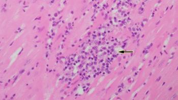 Figure 5. Higher magnification of interstitial myocarditis in the ventricle of the heart (arrow).