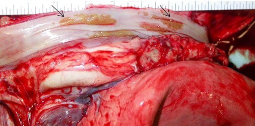 Mucosal ulcers covered by plaques of fibrin in the proximal 1/3 of the esophagus (arrows).