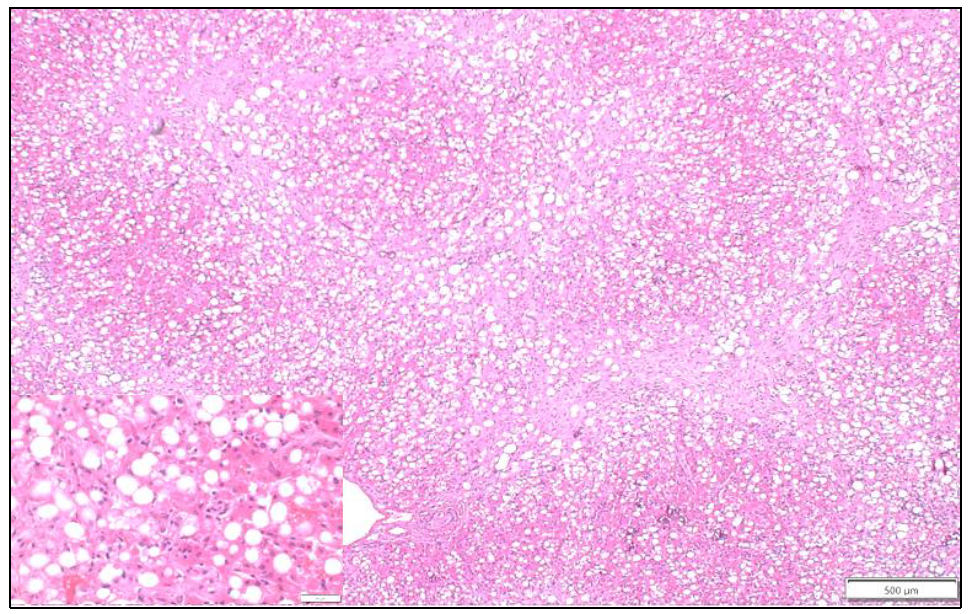 Figure 1. Bridging fibrosis throughout the liver (pale areas) with marked vacuolar change throughout (clear spaces). Inset shows higher magnification of vacuoles with intermingled inflammatory cells. H&E stain.