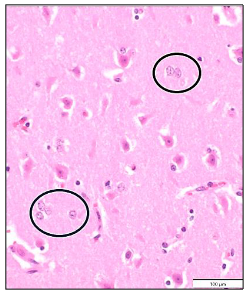 Figure 2. Section of the cerebrum showing swollen and clustered astrocytes (circled). H&E stain.