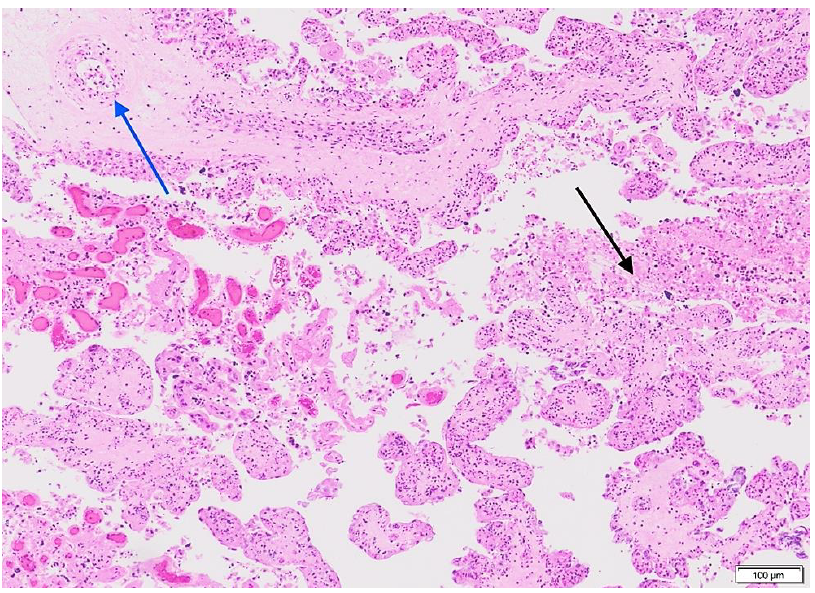 Figure 1.  Fibrin and neutrophilic inflammation (black arrow) and inflammation of blood vessel wall (blue arrow) in histologic section of placenta.  H&E.