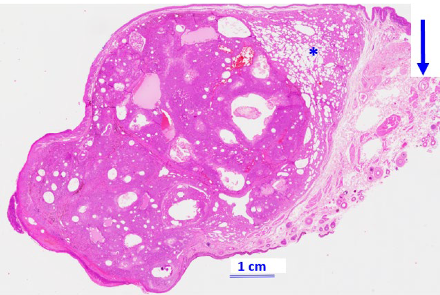 Figure 1.  Microscopic section of eyelid (H&E, 1x) capturing an expansile Meibomian gland adenoma at the mucocutaneous junction accompanied by adjacent lipogranulomatous inflammation known as chalazion (*), and nearby striated muscle where there is a parasitic structure within a myocyte (arrow). 