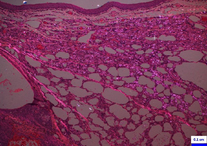 Figure 2. Microscopic section of eyelid (H&E, 10x, polarized light) capturing the chalazion, characterized by lipogranulomatous inflammation with linear birefringent material within the  cytoplasm of macrophages (*).