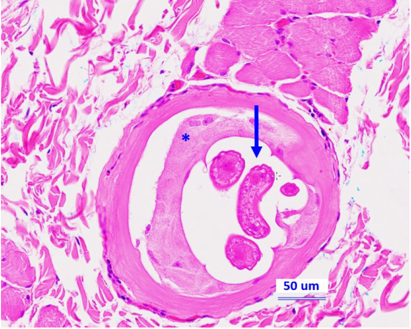 Figure 3.  Microscopic section of eyelid (H&E, 20x) capturing a nematode larva (arrow)  in a myocyte with nurse cell formation (*) compatible with Trichinella spp.