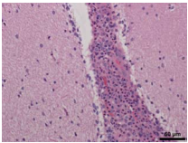 Figure 1. Severe neutrophilic meningitis associated with S. gallolyticus subsp. pasteurianus