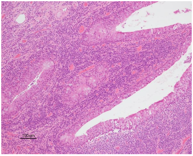  Chronic rhinitis with marked plasmacytic inflammation (H&E, 10X).