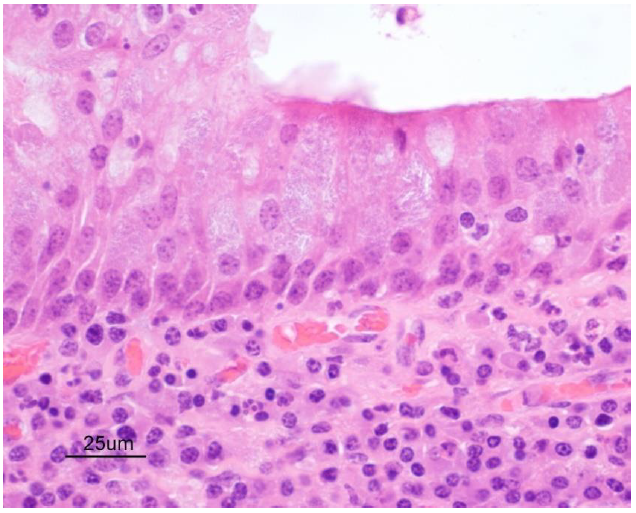   Numerous intracytoplasmic bacilli within nasal respiratory epithelium (H&E, 60X).