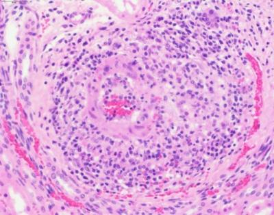 Figure 2.  Lymphocytic vasculitis of a renal arteriole, case 2. H&E stain