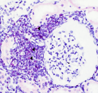 Figure 3.  Positive OvHV-2 in situ hybridization (red chromogen, arrowheads) in lymphocytes surrounding an arteriole adjacent to a renal glomerulus, case 2