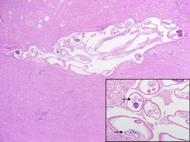  higher magnification of the parasite, arrows indicating the multinucleated intestine). (H&E)