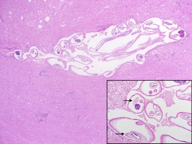  higher magnification of the parasite, arrows indicating the multinucleated intestine). (H&E)