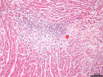  Cardiomyocyte loss and replacement by fibrosis and lymphocyte clusters.  Hematoxylin and eosin stain (10x).