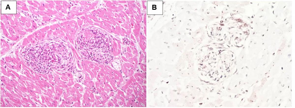 Figure 1. Vascular lesions in the myocardium.  A. Arterial “glomerulus-like” appearance with occlusive vascular wall thickening and hypercellularity.  H&E stain.  B. Positive immunostaining for BVDV.  IHC 