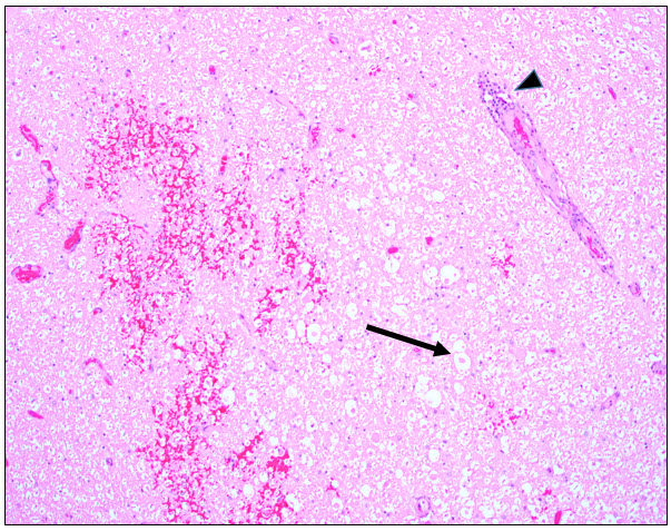Figure 1.  Hemorrhage within the spinal cord white matter with disruption of the parenchyma and damage to axons (arrow).  Lymphocytes and macrophages are present within the adventitia of an adjacent vessel in this area (arrowhead).  H&E stain.