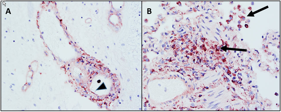 Figure 2.  Porcine circovirus 2 infection in a pig.  Spinal cord (2A) and lung (2B) with immunohistochemistry for PCV2.  There is positive immunostaining of scattered endothelial cells (arrowhead) in the spinal cord, and within alveolar macrophages and perivascular/peribronchiolar mononuclear cells in the lung (arrows).  Immunohistochemical staining for PCV-2 antigen, Nova Red chromagen