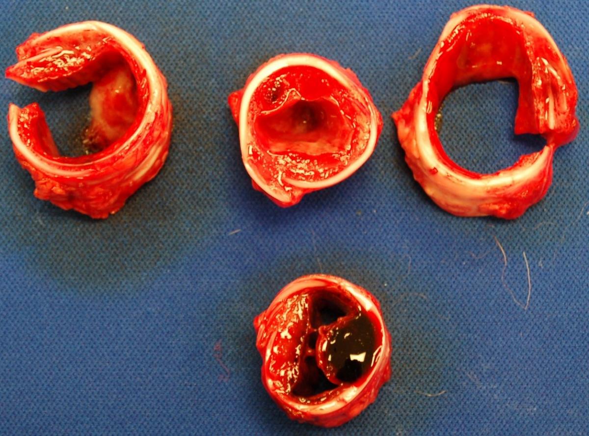 Figure 1. Tracheal cross-sections from multiple finisher pigs with necrohemorrhagic tracheitis. Note severe submucosal hemorrhage and edema, with resulting reduction in tracheal luminal area.