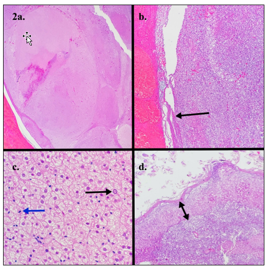  a thinned (atrophic) contralateral cortex (double headed black arrow). 10x.