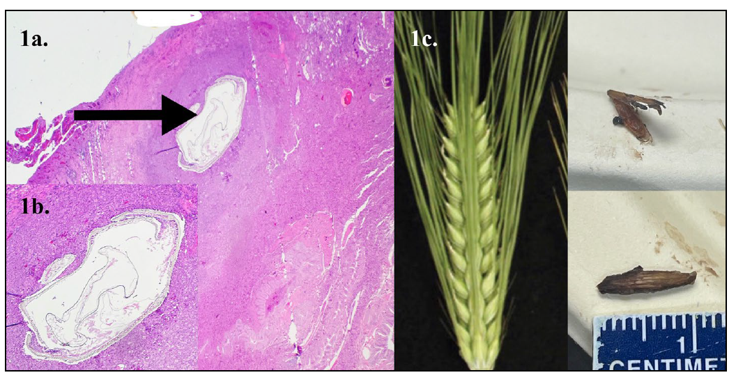 Figure 1. Lung/mediastinum/pericardial histopathology submission from a 2-year-old English springer spaniel hunting dog with a clinical history of lethargy, anorexia, pyrexia, dyspnea, pleural effusion, bronchopneumonia and draining tracts in the chest wall. 1a. Lung section with suppurative pleuritis and pyogranulomatous inflammation centered on foreign material (black arrow), consistent with plant fragments (H&E, 4x). 1b. Closer view of the entrapped plant material (H&E, 20x). 1c. Comparison of foxtail plant (grass awn) with plant material retrieved from the formalin-fixed section of lung submitted for histopathology. 