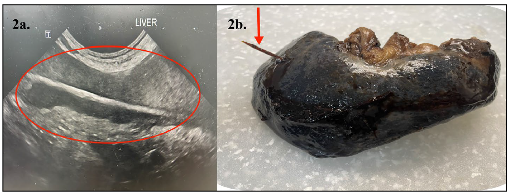 2. Pathology submission of a spleen from a 12-year-old pug with a history of lethargy, decreased appetite, vomiting, “hunched” posture, and pyrexia. 2a. Ultrasound detection of a foreign body (red circle) embedded in a thrombosed spleen. 2b. Gross view of the formalin-fixed spleen and the migrating foreign body (toothpick - red arrow) presumed to have been ingested with subsequent migration through the stomach wall into the spleen.