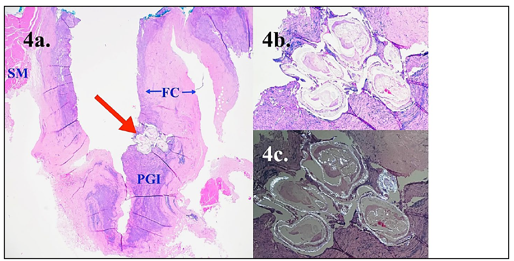 Figure 4. Histopathology submission of tissue from an 8-year-old whippet with a 2-month history of an expansile submandibular mass. 4a. Subcutaneous tissue from the submandibular region containing a central aggregate of plant material (presumed foxtail/grass awn) surrounded by pyogranulomatous inflammation (PGI) and an outer fibrous capsule (FC); skeletal muscle (SM). (H&E 4x). 4b. A closer view of the embedded plant material (H&E 20x). 4c. Refractile plant material under polarized light (H&E 20x).