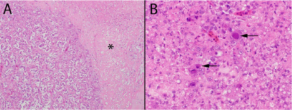 Figure 1. Lesions in the pancreas of guinea fowl associated with adenovirus infection. (A) There is extensive pancreatic necrosis (*) with inflammation, atrophy and loss of parenchyma. (B) There are numerous intranuclear inclusion bodies consistent with adenovirus (arrows).  H&E stain.
